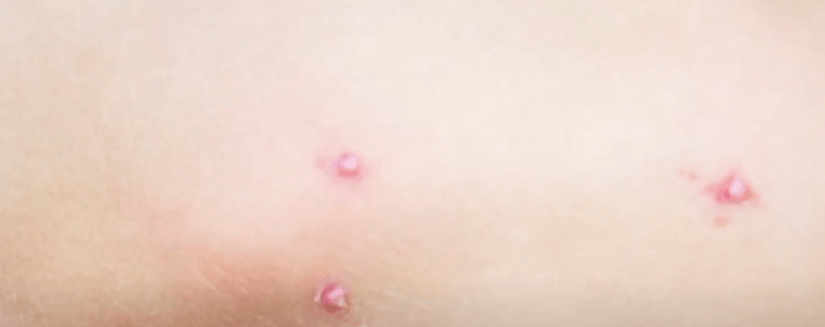 PARA EVITAR LA VARICELA SE DEBE VACUNAR  A LOS&nbsp;NIÑOS