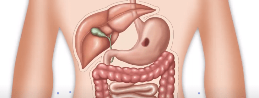 RECOMIENDAN CURAR LA GASTRITIS PARA EVITAR EL CANCER DE&nbsp;ESTOMAGO