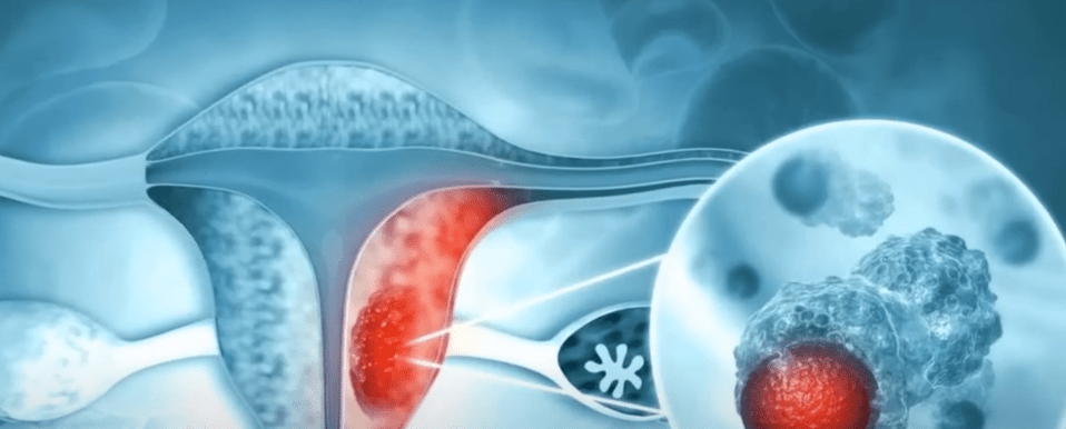 SEDES: REGISTRAN 45 NUEVOS DE CÁNCER EN&nbsp;TARIJA