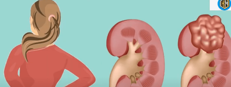 DIETA SALUDABLE CON POCA SAL GARANTIZA RIÑONES&nbsp;SANOS