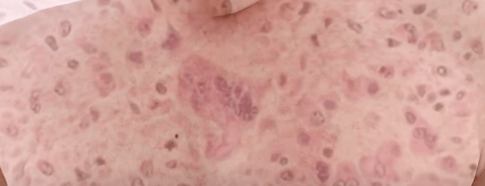 ANTE 3 CASOS DE SARAMPIÓN EXTREMAN CONTROLES SANITARIOS EN&nbsp;TARIJA