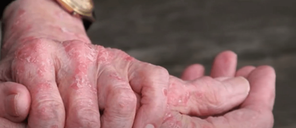 SEDES: MUJER MAYOR VUELVE A PRESENTAR LEPRA TRAS 30&nbsp;AÑOS