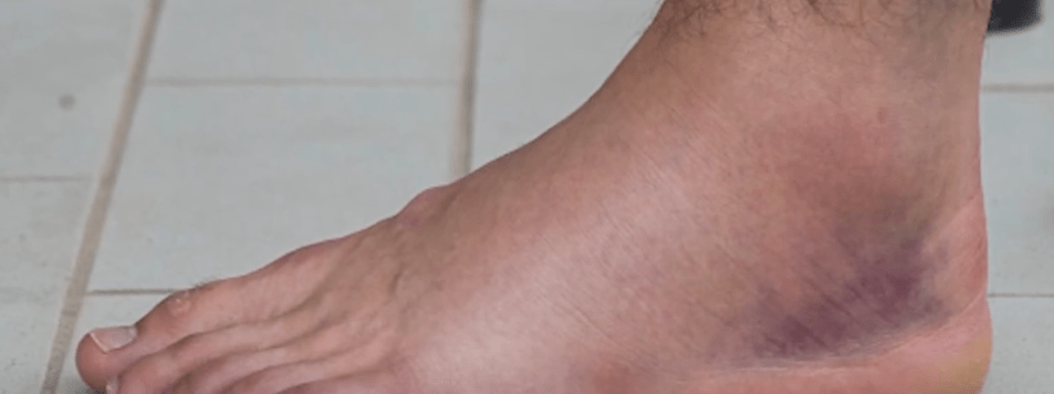 ¿QUÉ HACER ANTE UNA TORCEDURA DEL&nbsp;PIE?