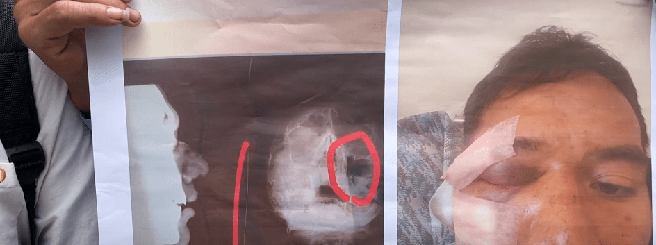 CAMPESINOS EN EMERGENCIA POR VIOLENTA AGRESIÓN A DIRIGENTE DAVID&nbsp;YUCA