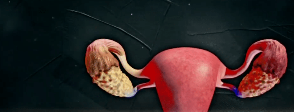 PRESENCIA DE OVARIO POLIQUISTICO EN MUJERES ES&nbsp;FRECUENTE