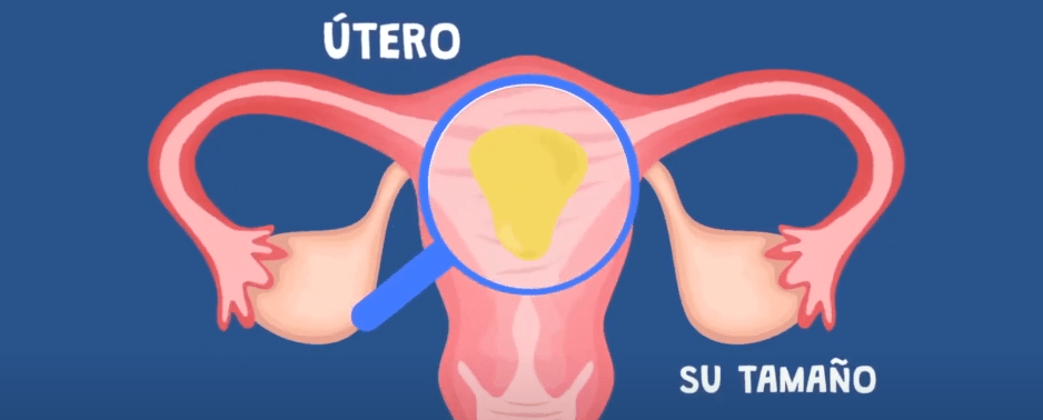 GINECÓLGOS ASEGURAN QUE CÁNCER DE CUELLO UTERINO ES&nbsp;TRATABLE