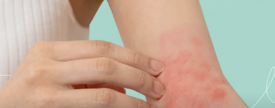 COMO TRATAR LA XEROSIS O PIEL&nbsp;SECA