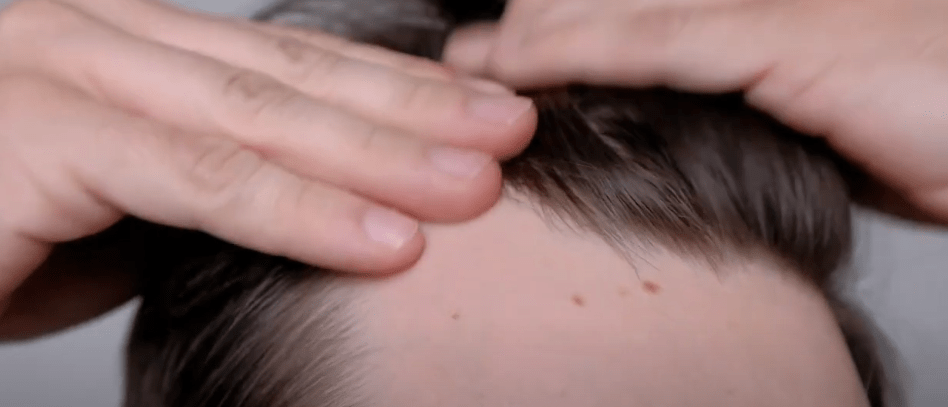 CAÍDA DEL CABELLO PUEDE SER&nbsp;REVERTIDA