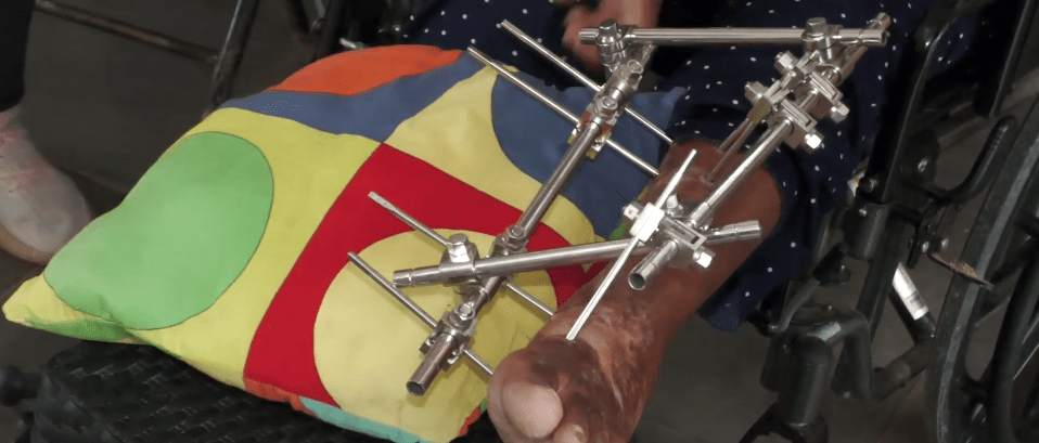 VÍCTIMA DE ACCIDENTE DE LA “VILLA DEL NORTE” ESPERA PAGO DE GASTOS&nbsp;MÉDICOS